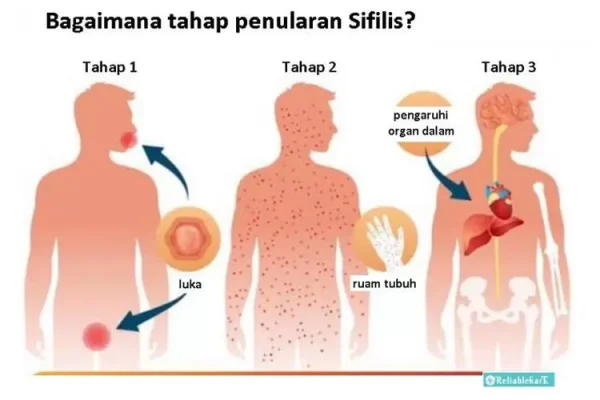 BAHAYA PENYAKIT SIFLIS