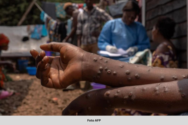 WHO LANCAR PELAN HENTI PENULARAN MPOX