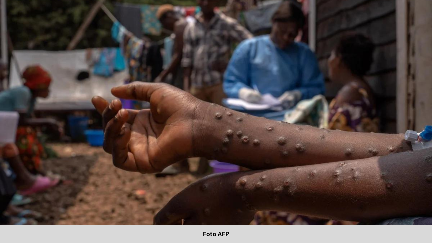 WHO LANCAR PELAN HENTI PENULARAN MPOX